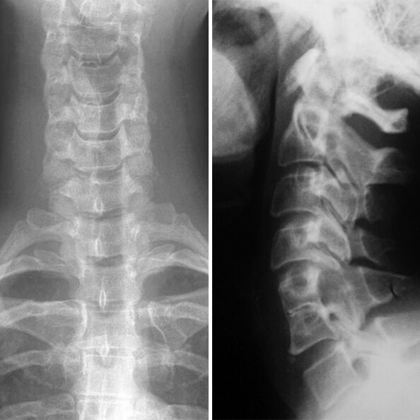 X -Ray της αυχενικής σπονδυλικής στήλης
