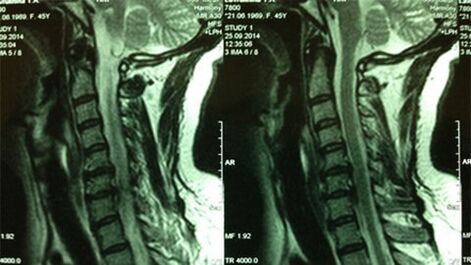 MRI του τμήματος του τραχήλου
