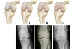 μέθοδοι για τη διάγνωση της αρθρώσεως του γόνατος
