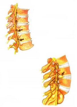 απεικόνιση της οστεοχόνδρωσης της σπονδυλικής στήλης