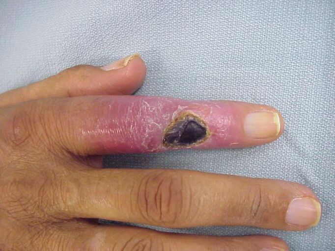 οστεομυελίτιδα ως αιτία πόνου στις αρθρώσεις των δακτύλων